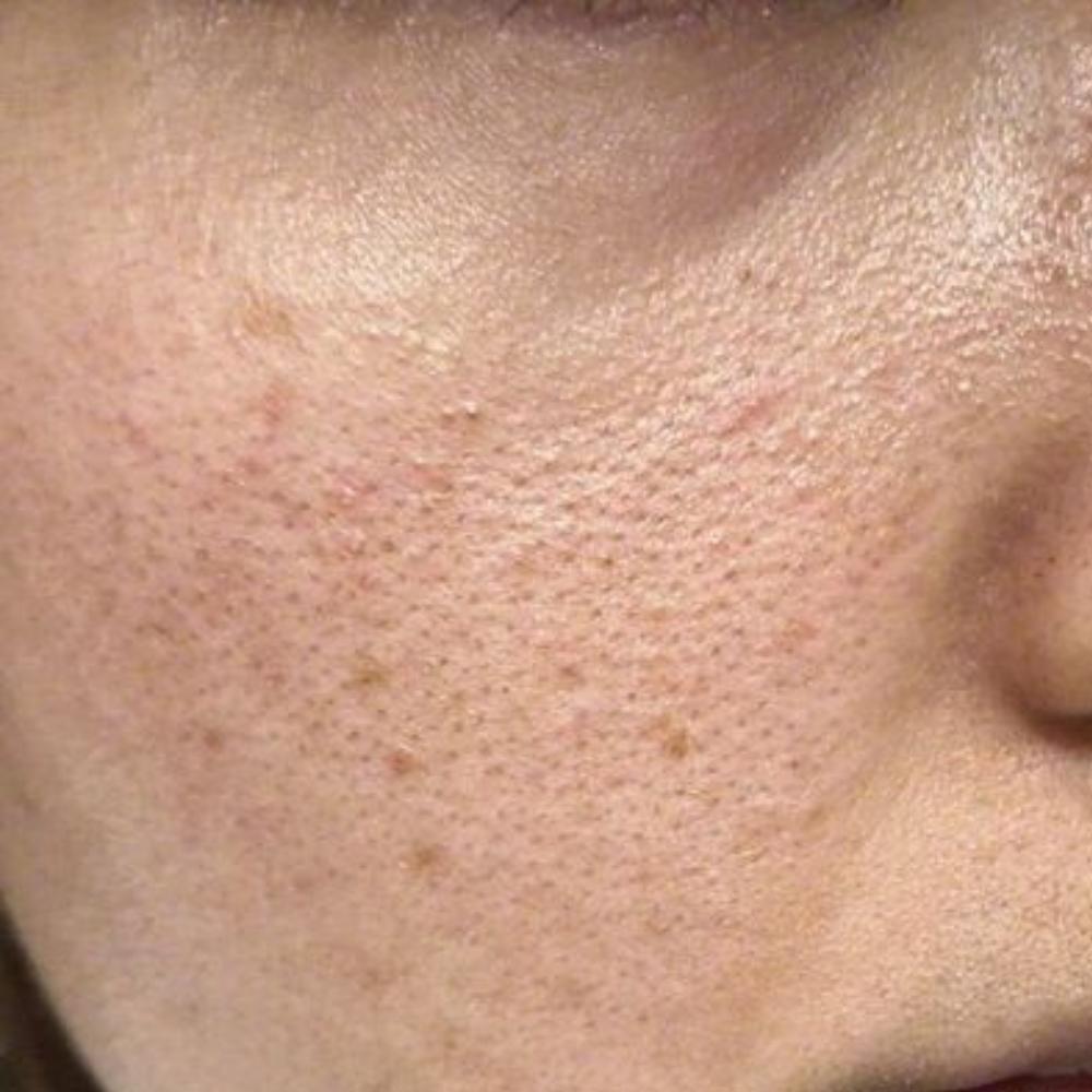 skincare-pores